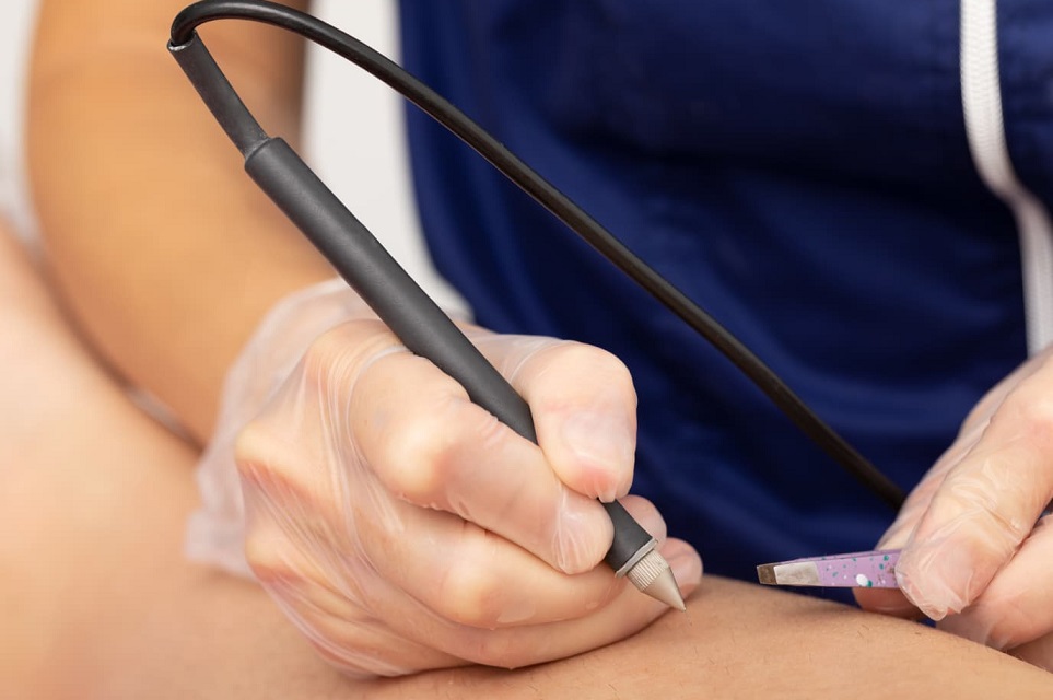 Épilation Laser
